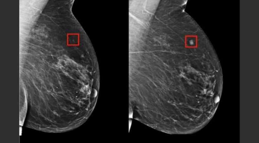 Una IA detecta el cáncer de mama cuatro años antes de que se desarrolle en pacientes