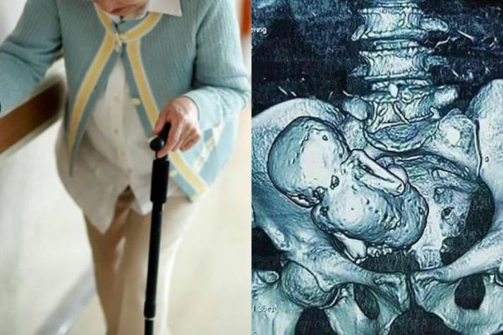 [FOTOS] Anciana va al médico por dolor de estómago y descubren "feto petrificado" en su interior