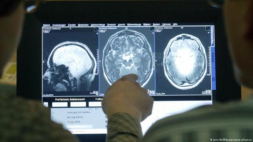 Nuevo medicamento entrega resultados prometedores en tratamiento contra el Alzheimer