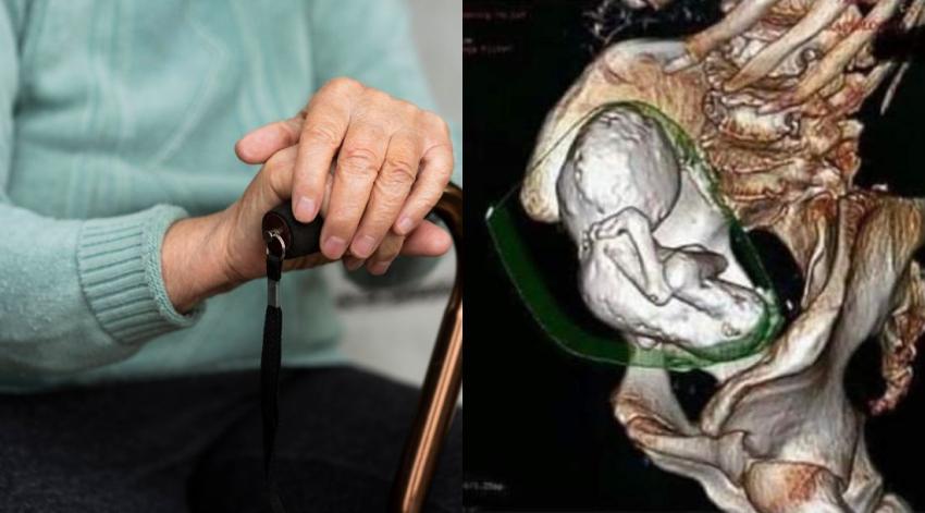 Insólito: anciana llevaba en su cuerpo un feto momificado por 35 años y nunca se dio cuenta