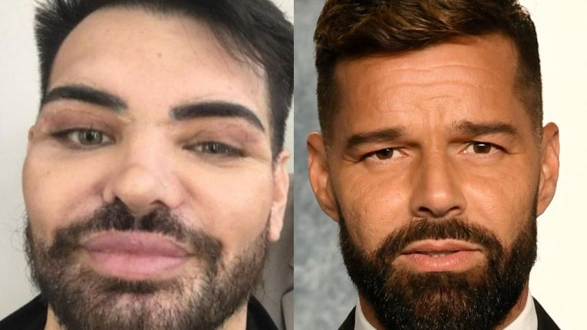Hombre se operó más de 20 veces para parecerse a Ricky Martin: Sufrió de parálisis facial tras mala praxis