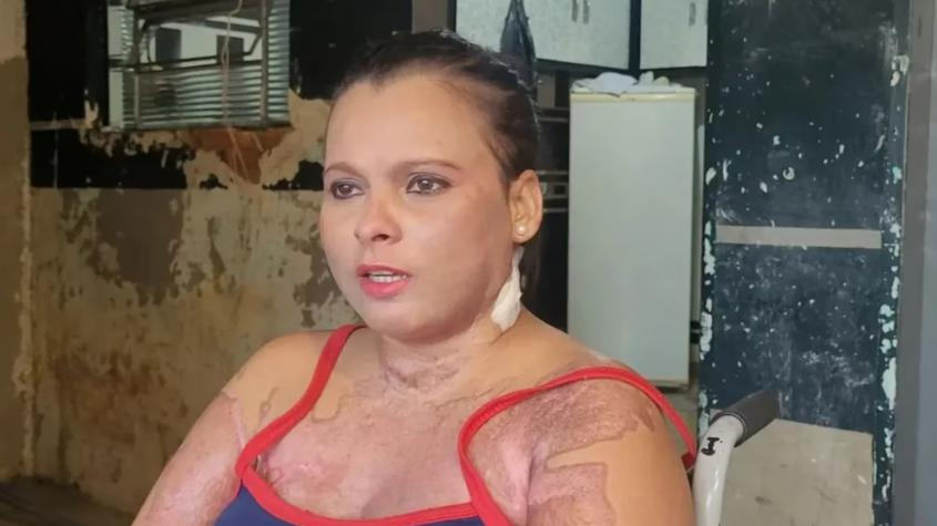Mujer que despertó del coma denunció a su marido por prenderle fuego: "Él tiene la culpa"
