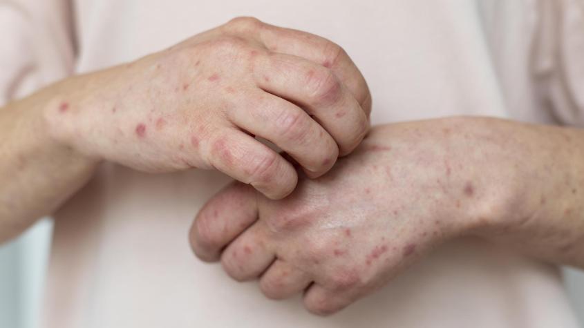 Seremi de Salud confirma caso de sarampión importado en la RM: No estaba vacunado contra el virus