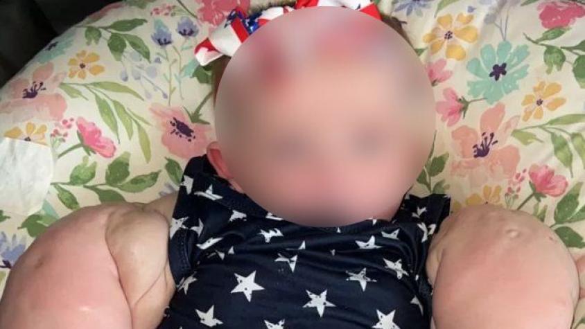 La apodan "baby Hulk": Niña nació con extraña enfermedad que provoca que se le hinchen los brazos y pecho