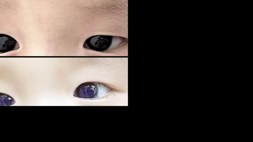 Un niño cambió radicalmente el color de sus ojos tras recibir un tratamiento antiviral