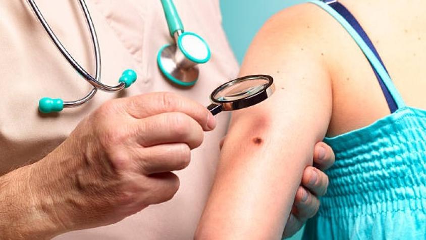 Vida y Salud: Cuidados y prevención del cáncer de piel