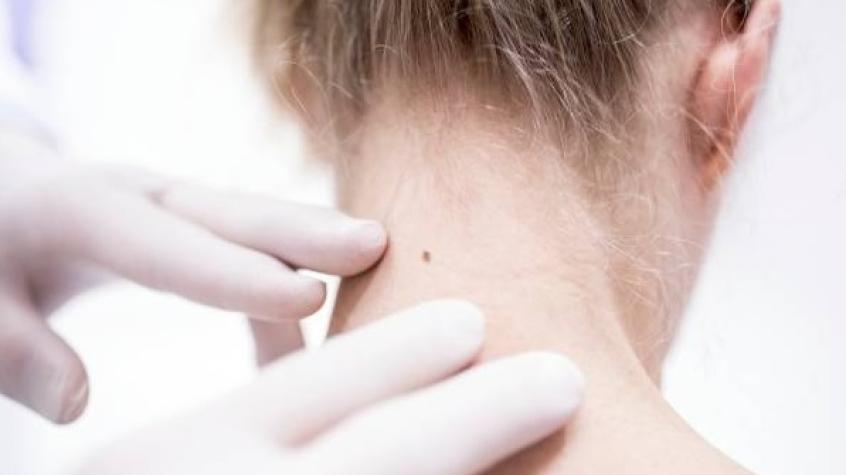 Vida y Salud: ¿Qué tipos de cáncer de piel existen? 