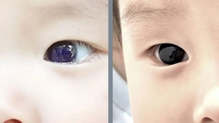 Bebé cambia color de ojos tras tratamiento contra el Covid