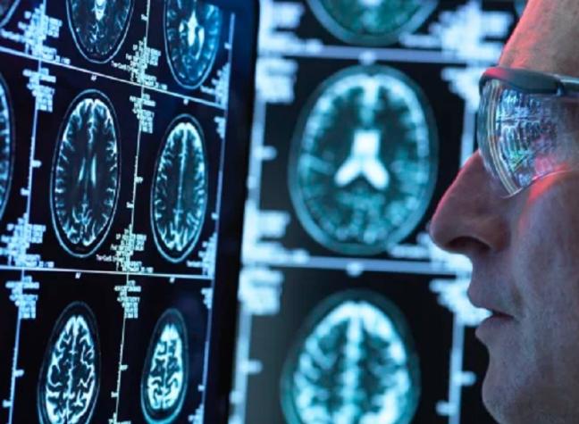 Para tratar enfermedad neurológica: Doctores "desconectaron" la mitad del cerebro de una niña