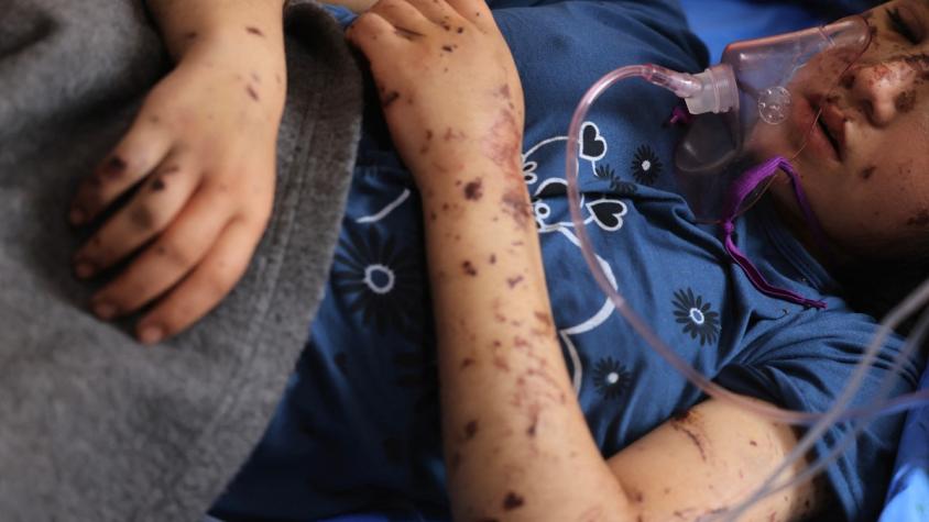 "¡Devuélvanme mis piernas!": El grito de niños amputados en la guerra de Gaza