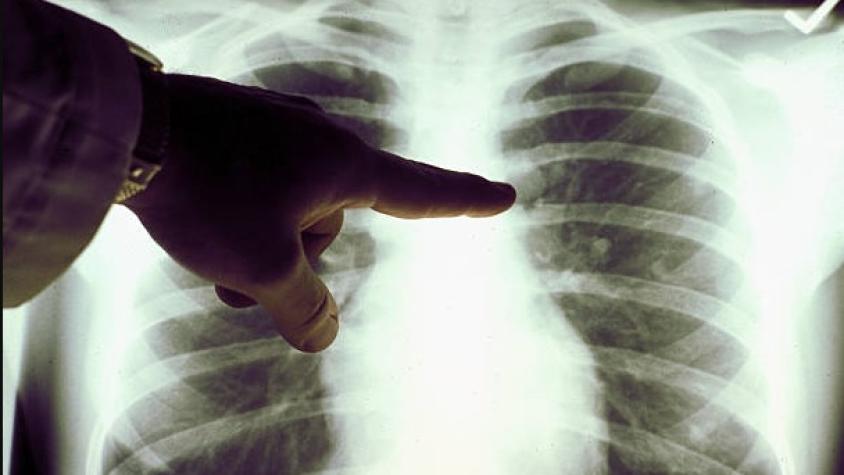 La relevancia del chequeo preventivo en el cáncer de pulmón 