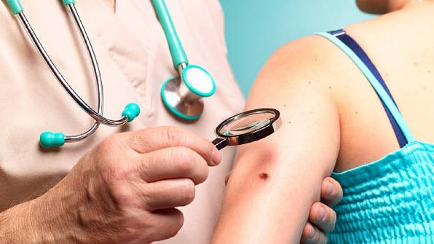 Vida y Salud: ¿Cómo prevenir el cáncer de piel?