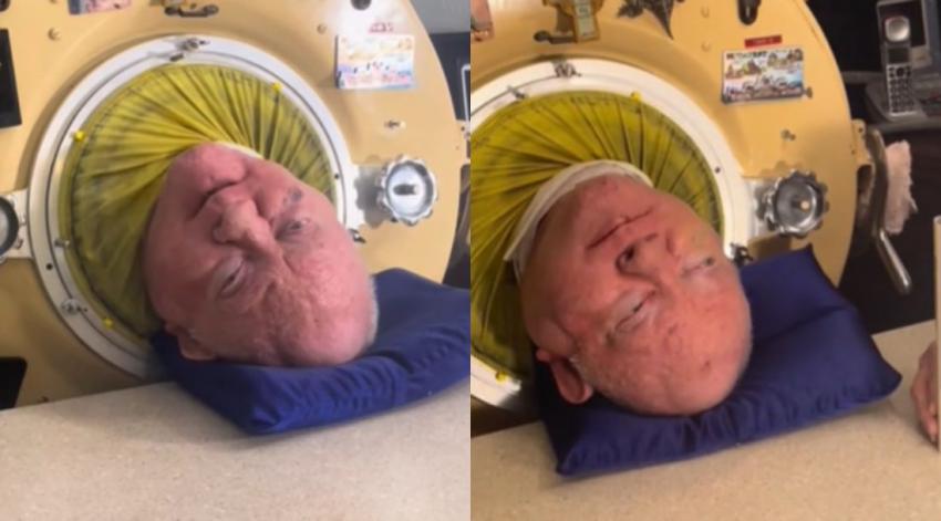 Hombre que ha vivido por más de 70 años en un pulmón de acero revela cómo va al baño