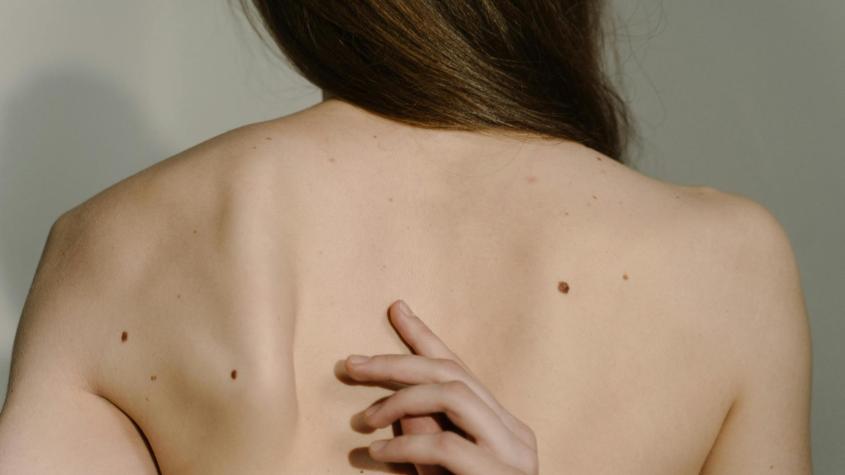 Cáncer a la piel: Cómo saber si mis lunares son peligrosos