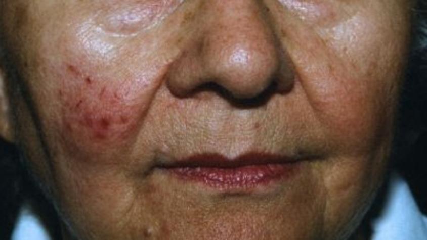 Demodex: el ácaro presente en nuestra piel que al multiplicarse puede generar enfermedades