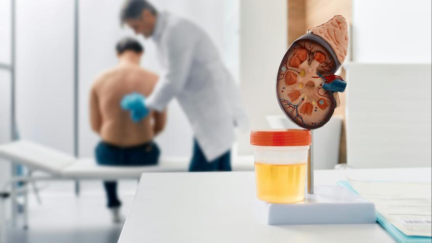 Enfermedad renal crónica: la epidemia ‘silenciosa’ que podría superar al cáncer en mortalidad
