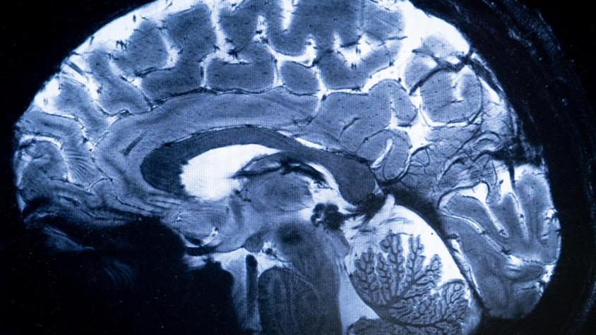 "Podríamos estar haciendo diagnósticos prematuros": Nuevos hallazgos sobre qué pasa en el cerebro al morir