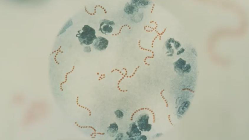Bacteria asesina: ¿Cuáles son los signos de alarma para consultar?