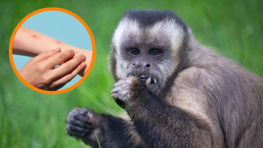 La OMS preocupada por una nueva cepa de la 'viruela del mono'