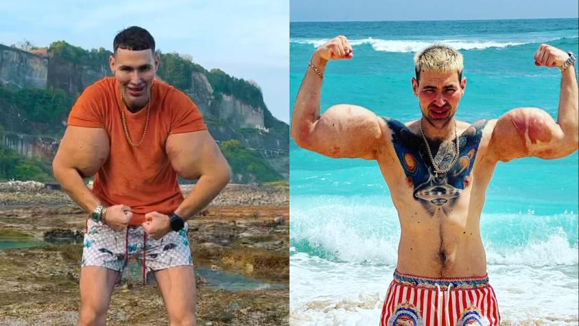 'Popeye ruso' que se inyectó aceite en los bíceps reveló que ahora peligra su vida: está hospitalizado 'Popeye ruso' que se inyectó aceite en los bíceps reveló que ahora peligra su vida: está hospitalizado