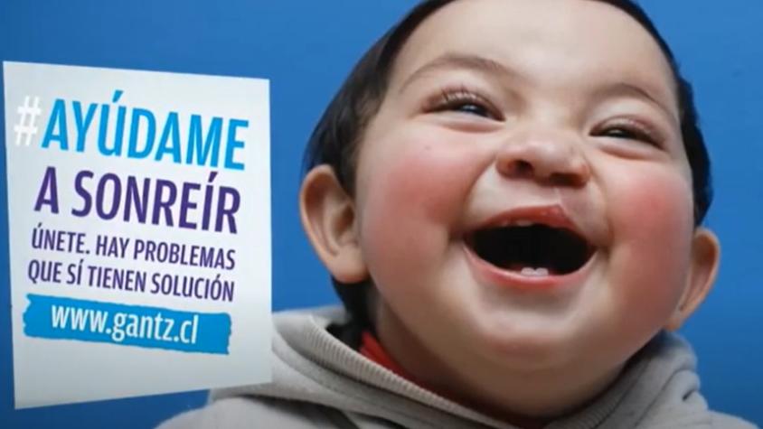 "Juntos cambiemos vidas": Ya hay fecha para campaña en apoyo a niños con labio leporino