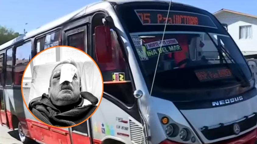 Chofer de micro sufre brutal golpiza en Villa Alemana: fue atacado con una manopla y podría perder su ojo