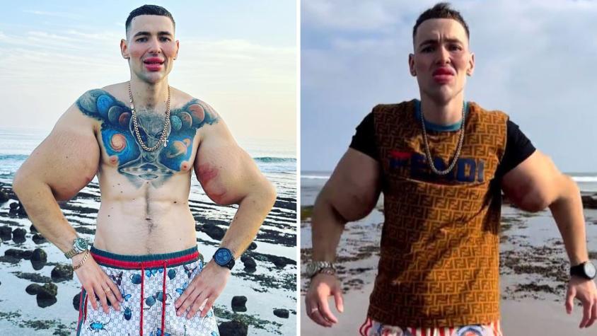 El dramático presente del ‘Popeye ruso’: arriesga perder los brazos tras inyectarse vaselina en los bíceps