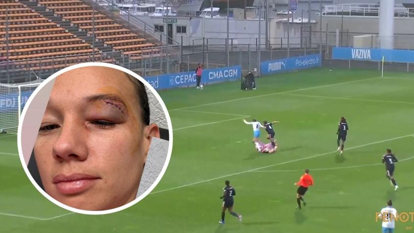IMÁGENES SENSIBLES: Christiane Endler tuvo que recibir puntos de sutura tras golpe durante la Copa de Francia