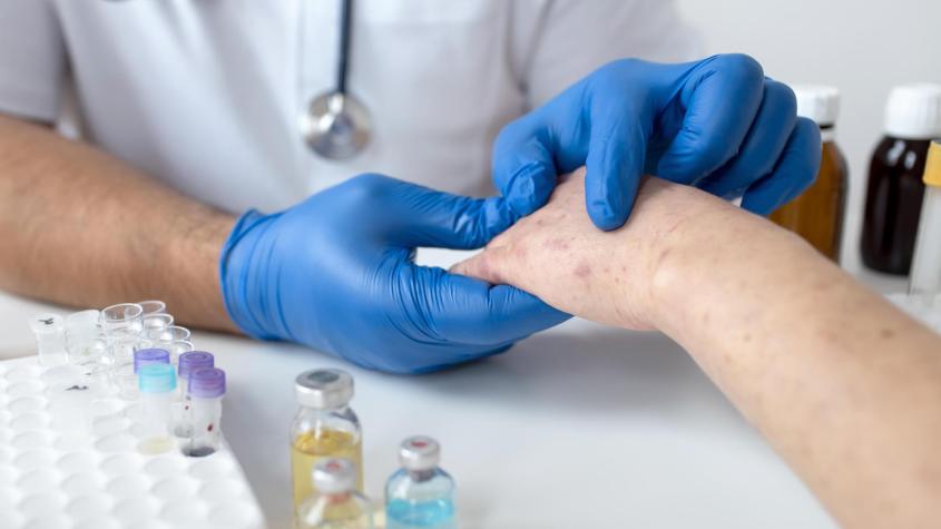 Primer caso importado de sarampión en Chile desde 2023: ¿Qué debo hacer si creo tener alguno de estos síntomas?