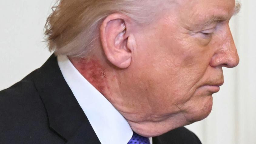 Trump visto con una gran mancha roja en el cuello