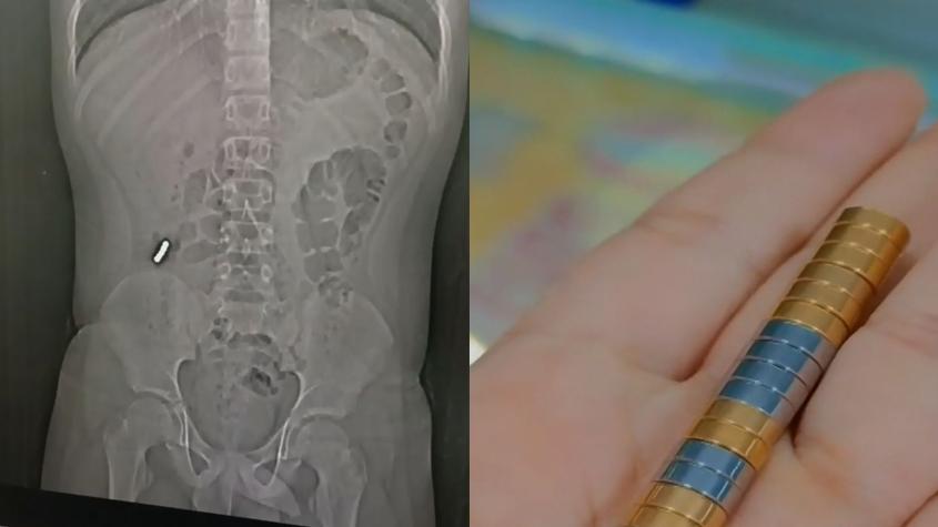 Siete menores operados en Chile por reto viral: uno tiene nueve perforaciones y otro ingirió 11 imanes