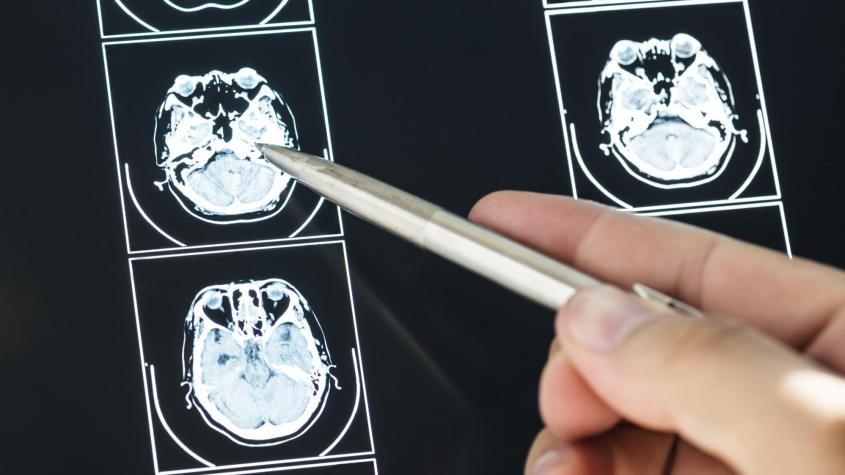 ACV en Chile: el error que más se repite y que puede cambiar completamente el pronóstico