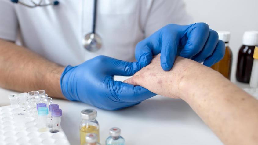 ¿Cómo detectar el lupus? Los síntomas que muchas veces pasan desapercibidos