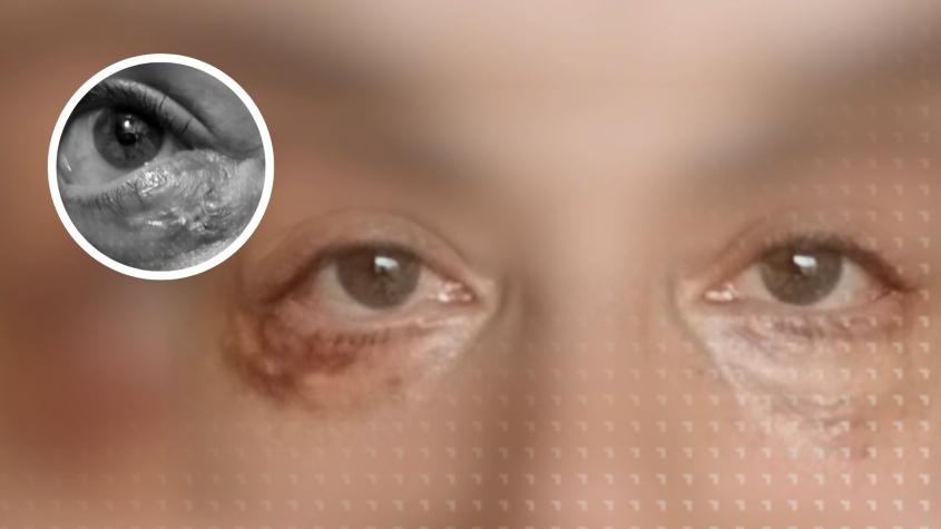 “Incluso él se sorprendía”: chilena denuncia secuelas tras cirugía estética de ojeras y presenta querella contra médico