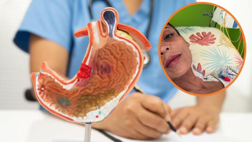 Por caso de Katherine Orellana: las señales de alerta para evitar úlceras tras un bypass gástrico