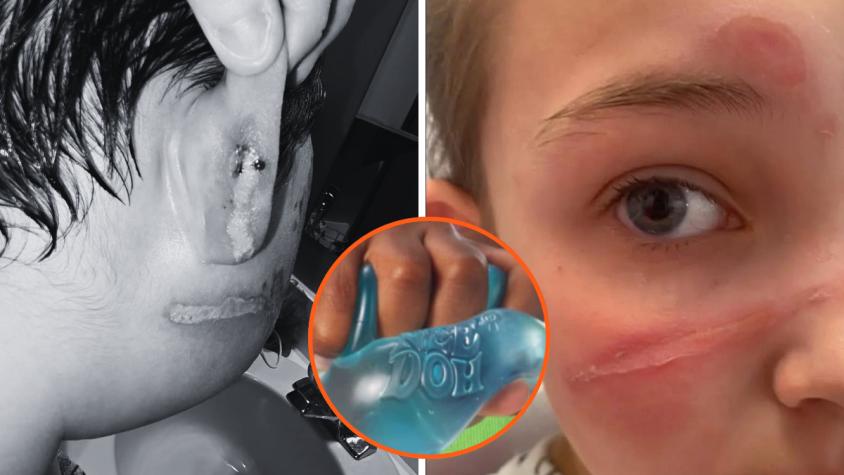Alerta en EE.UU. por juguete que está causando graves quemaduras en niños: producto está disponible en Chile Alerta en EE.UU. por juguete que está causando graves quemaduras en niños: producto está disponible en Chile